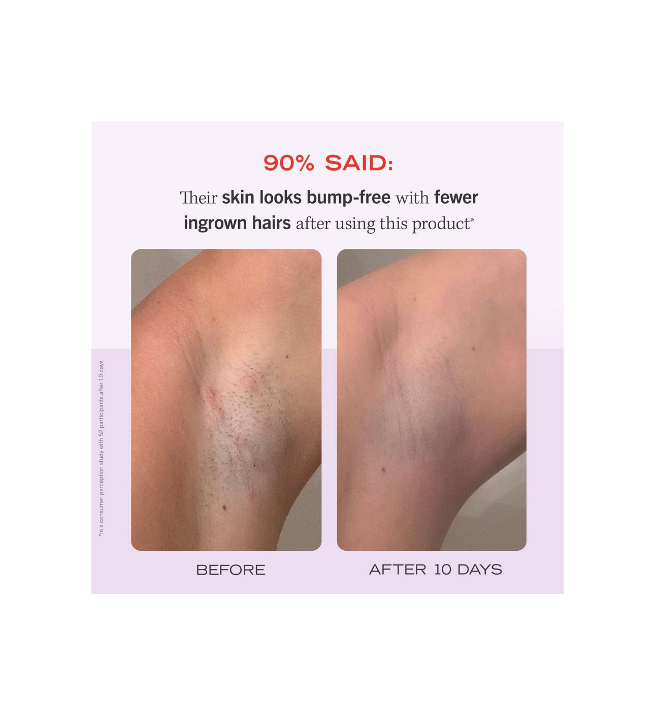 First Aid Beauty- Ingrown Hair Pads with BHA & AHA