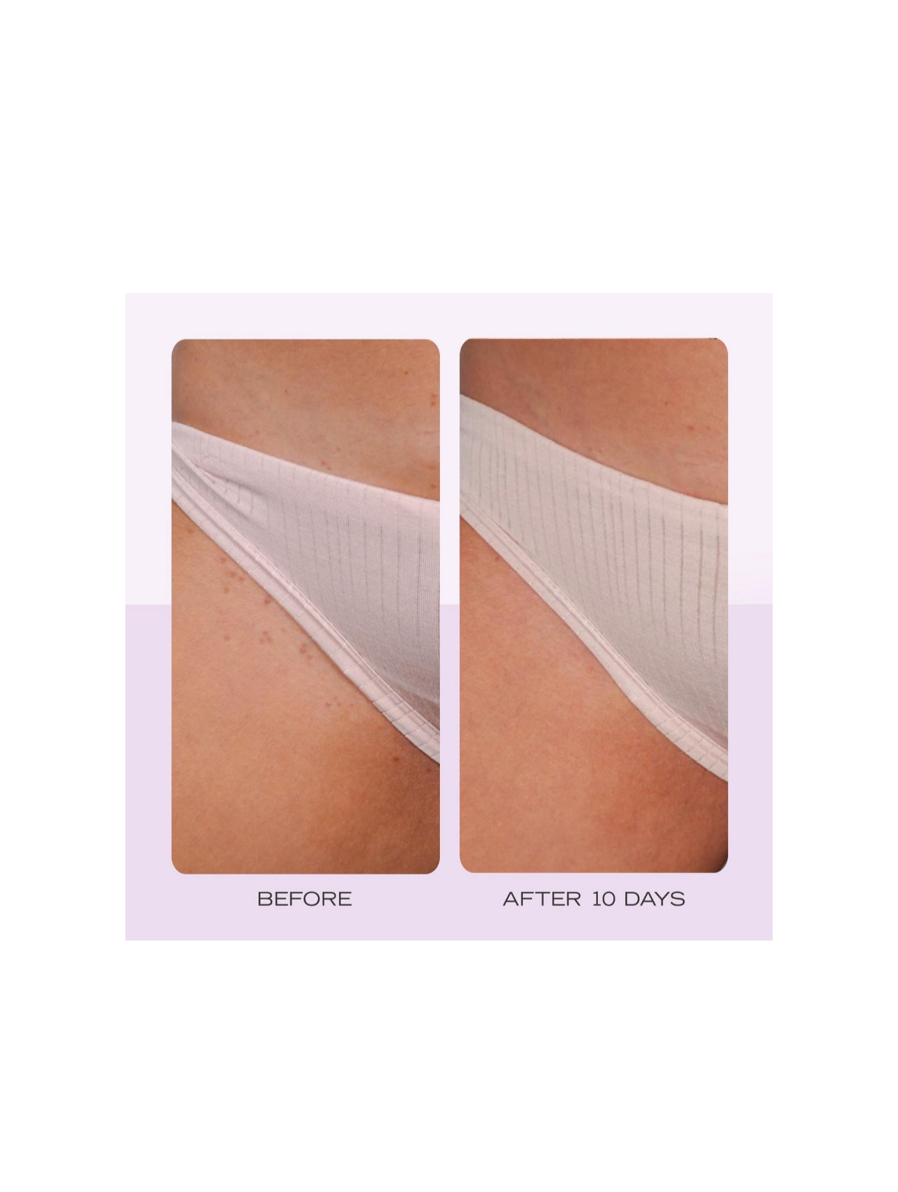 First Aid Beauty- Ingrown Hair Pads with BHA & AHA