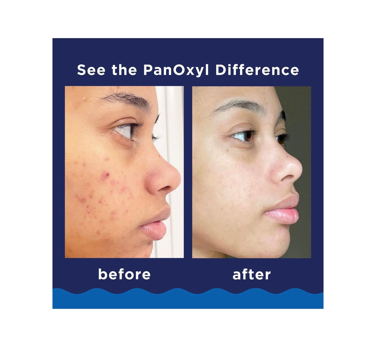 PanOxyl- Acne Foaming Wash with 10%
Benzoyl Peroxide
