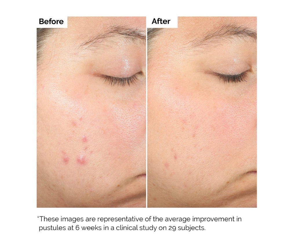 The Ordinary- Salicylic Acid 2% Acne Serum