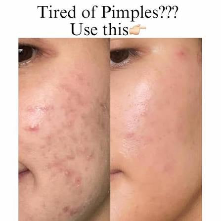 Neutrogena- 0.5% Salicylic Acid SOS GEL