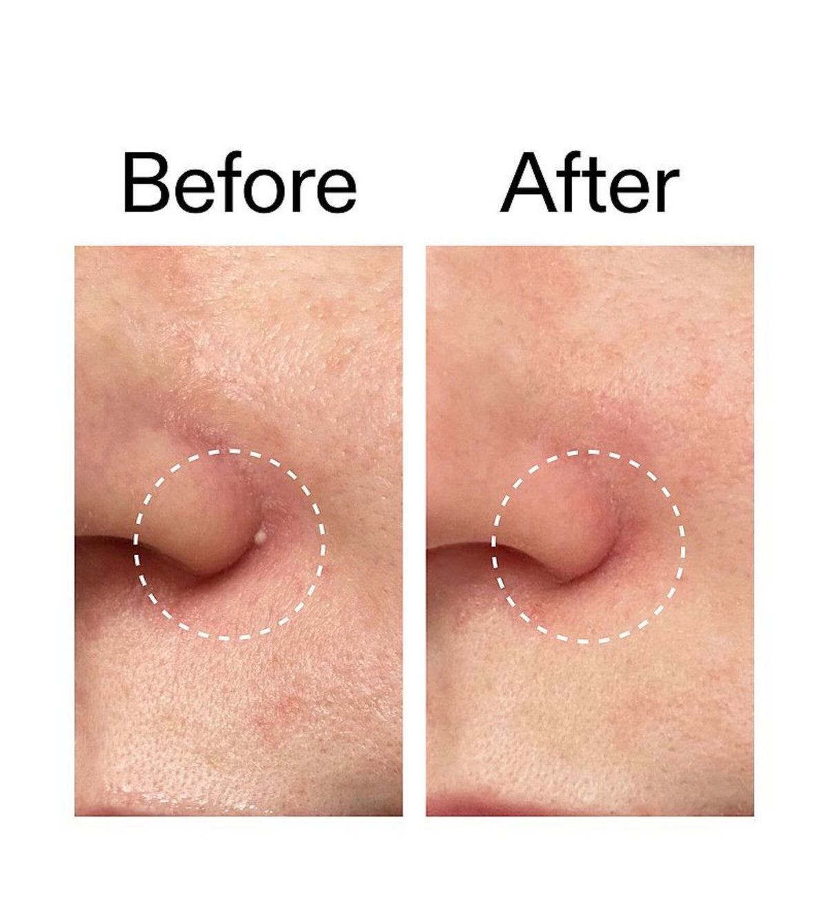 The INKEY List- Hydrocolloid Invisible Pimple Patches + Salicylic Acid