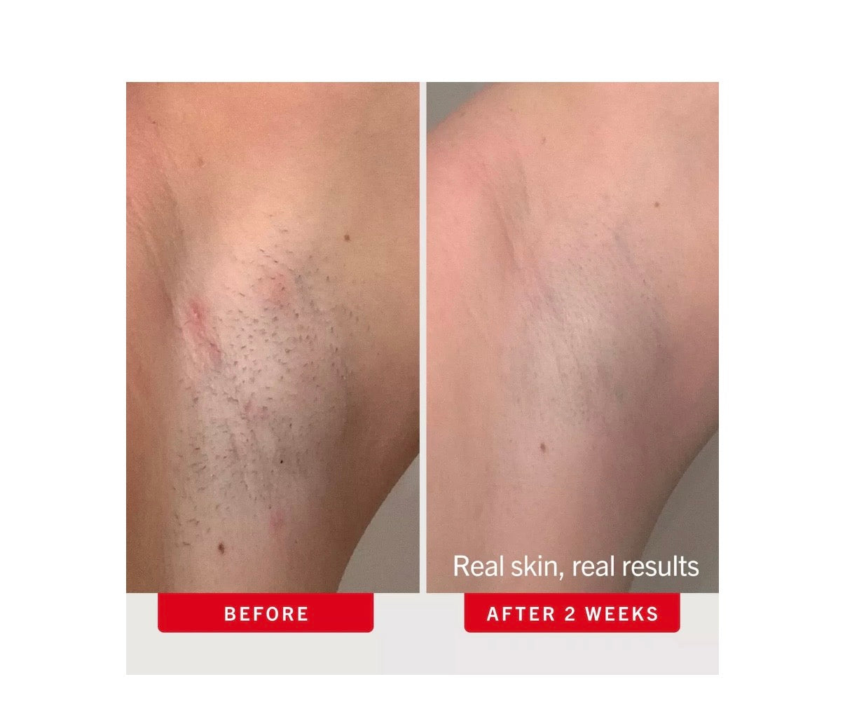 First Aid Beauty- Ingrown Hair Pads with BHA & AHA