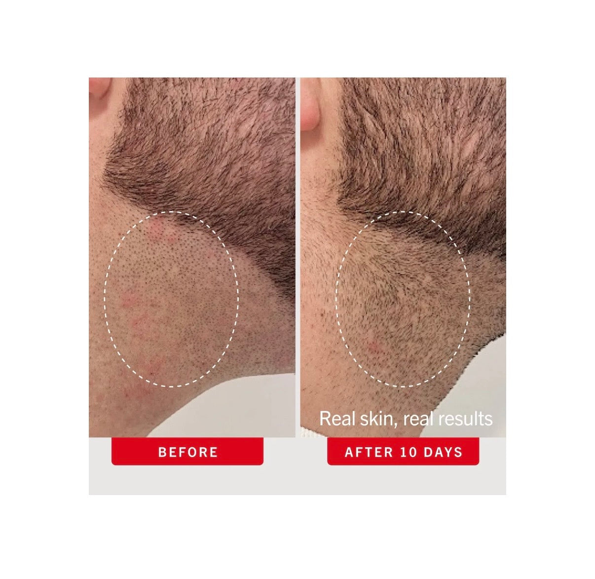 First Aid Beauty- Ingrown Hair Pads with BHA & AHA