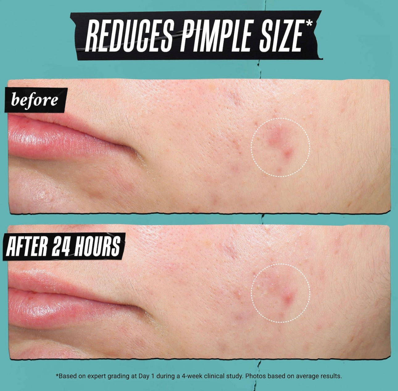 Kiehl’s- Truly Targeted Acne-Clearing Liquid Pimple Patch with Salicylic Acid