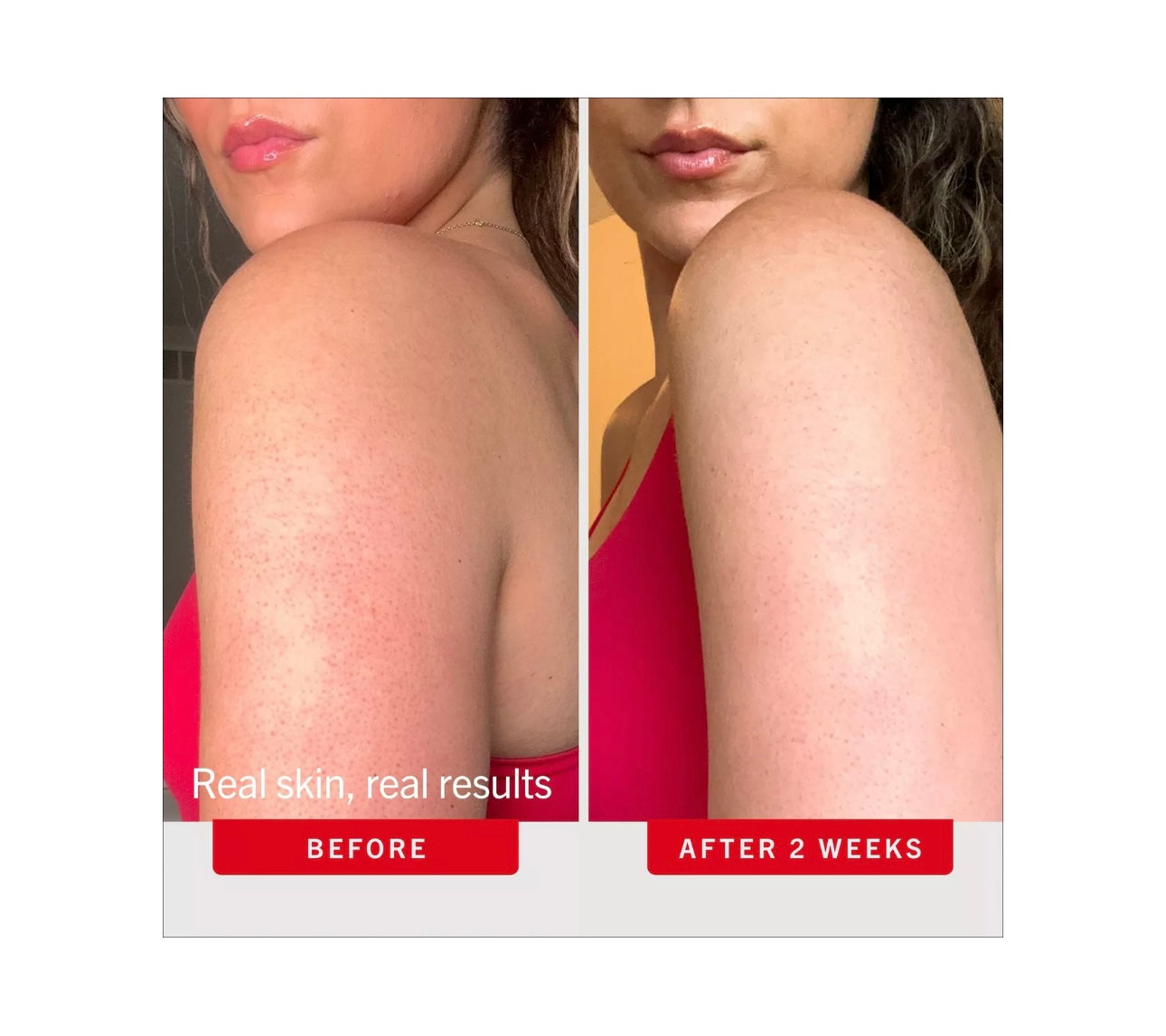 First Aid Beauty- KP Bump Eraser Body Scrub & Exfoliater with 10% AHA