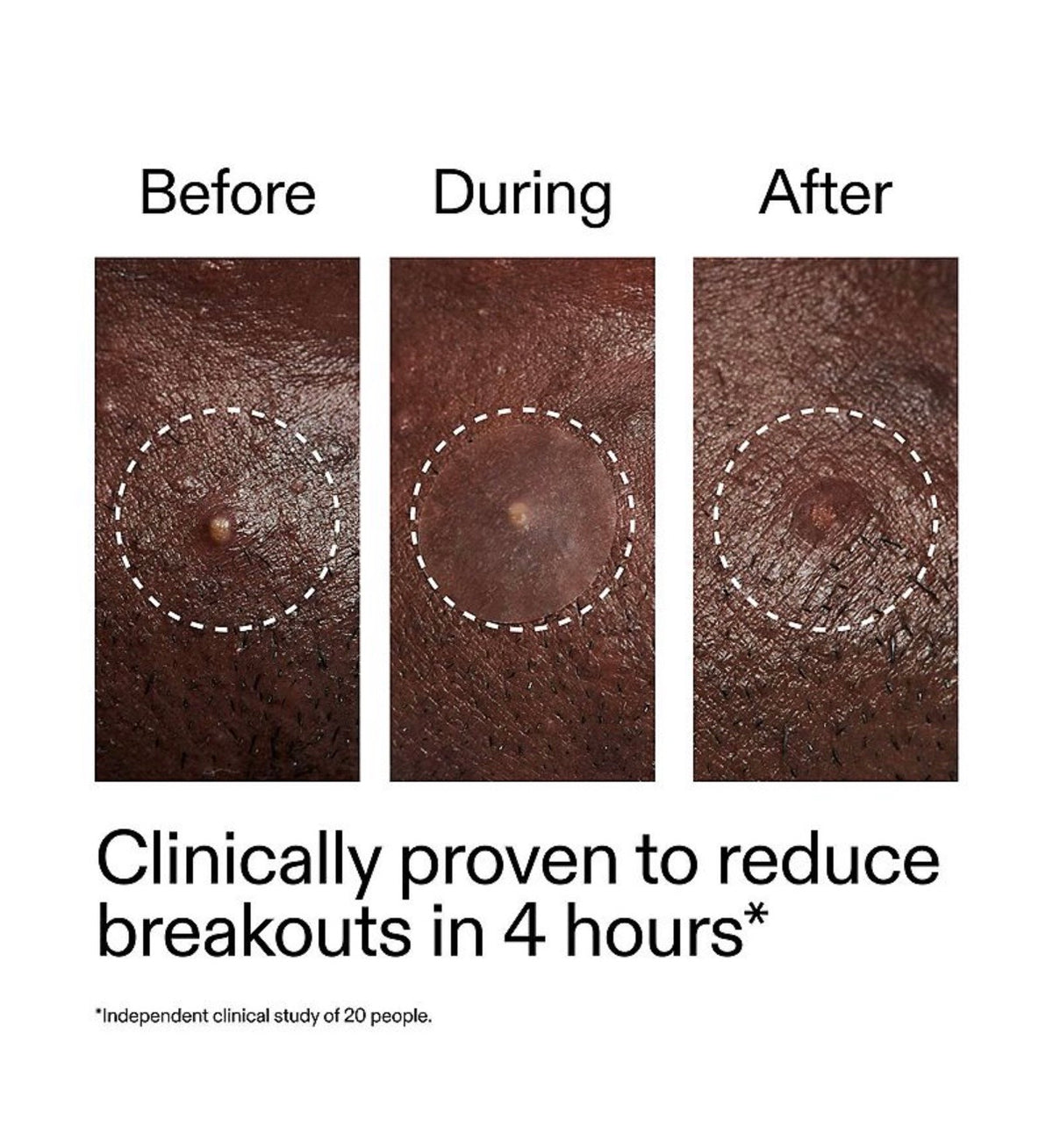 The INKEY List- Hydrocolloid Invisible Pimple Patches + Salicylic Acid