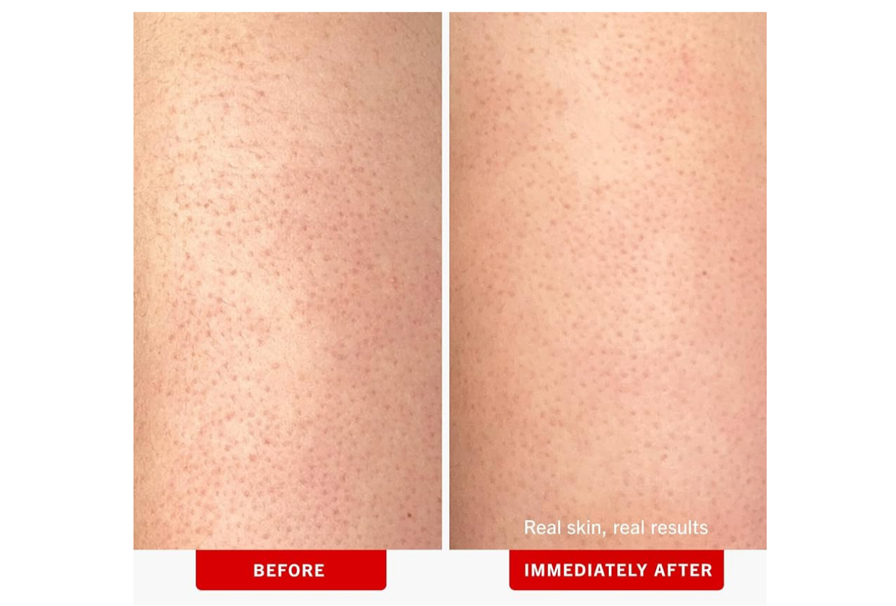 First Aid Beauty- KP Bump Eraser Body Scrub with 10% AHA