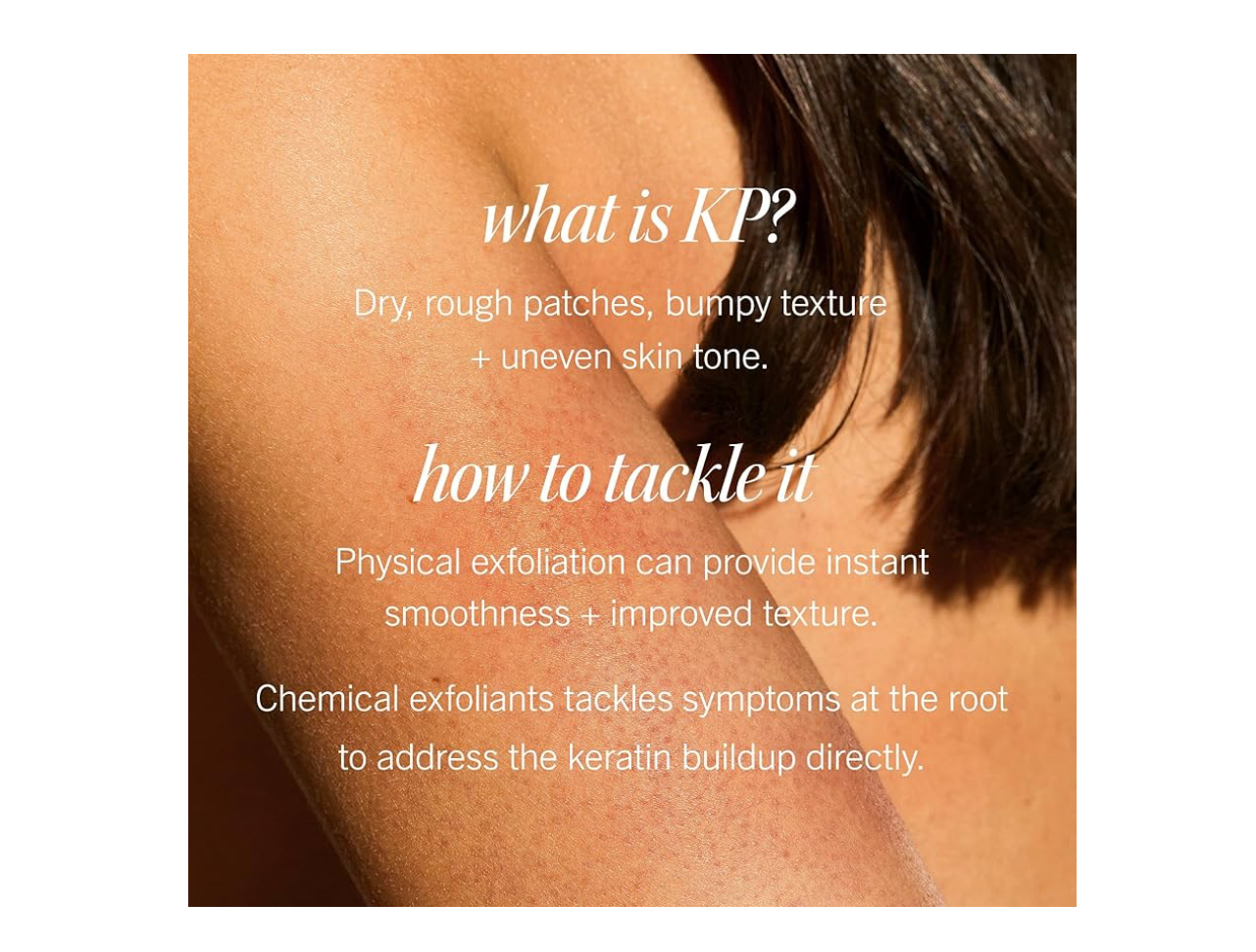 First Aid Beauty- KP Bump Eraser Body Scrub with 10% AHA