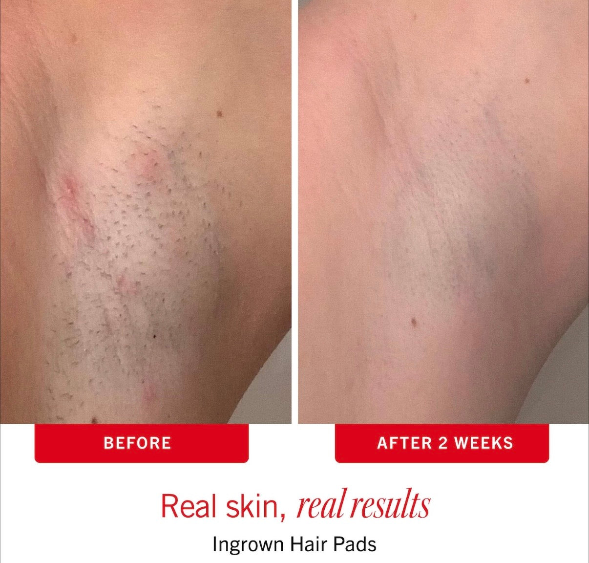 FIRST AID BEAUTY- Smooth Skin Body Bestsellers Body Care Duo with KP Scrub