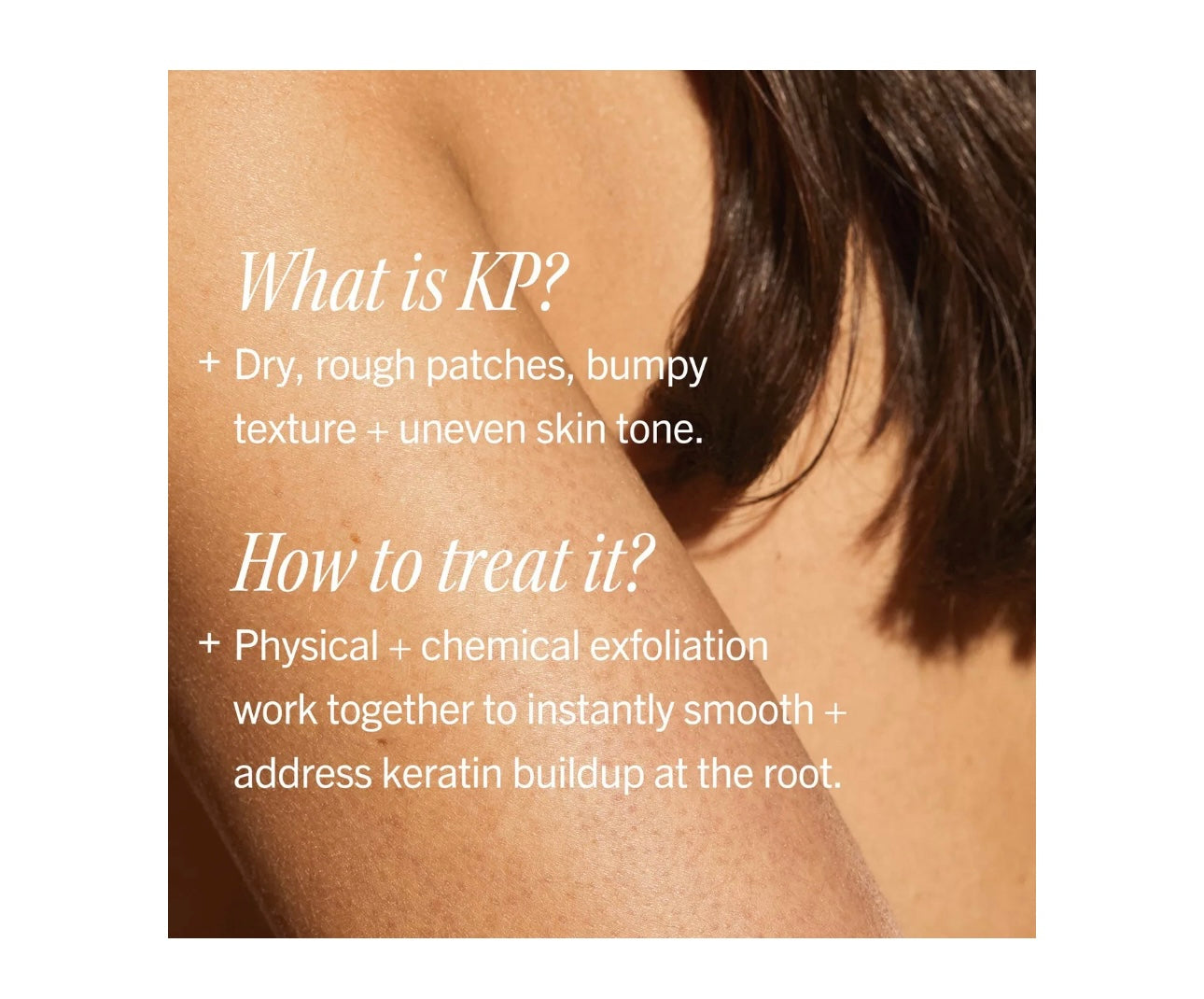 First Aid Beauty- KP Bump Eraser Body Scrub & Exfoliater with 10% AHA