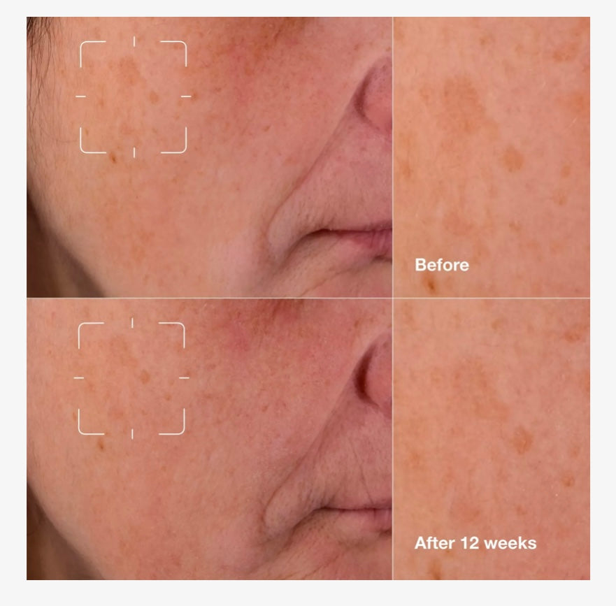 Clinique- Even Better Clinical Radical Dark Spot Corrector + Interrupter Serum