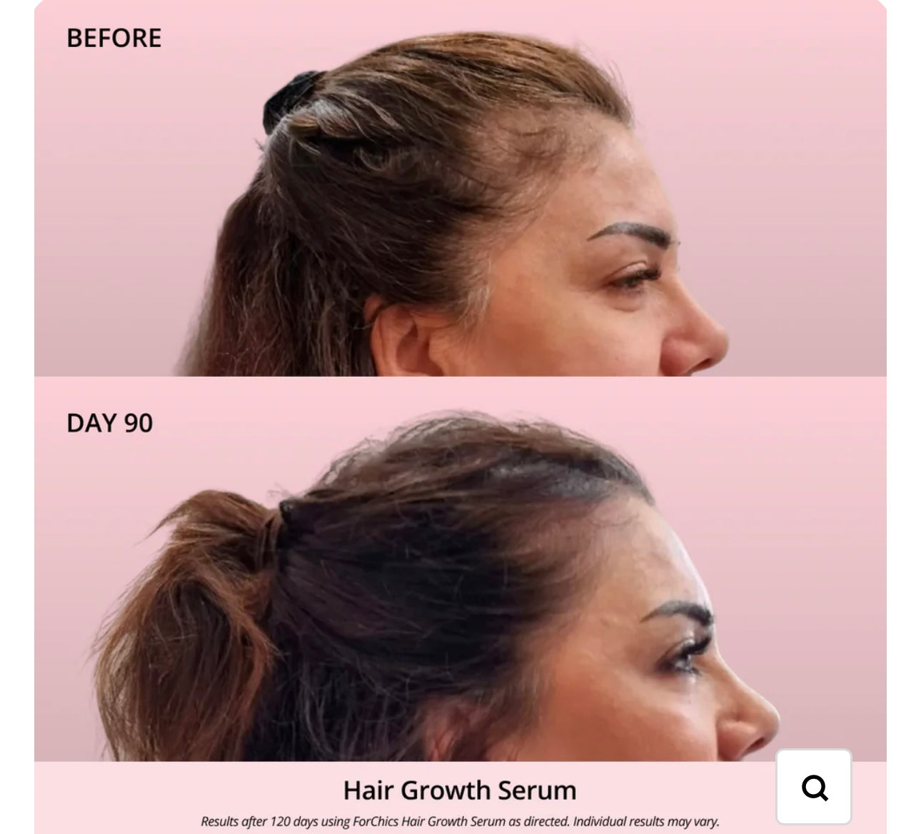 FORCHICS- Hair Growth Oil Spray