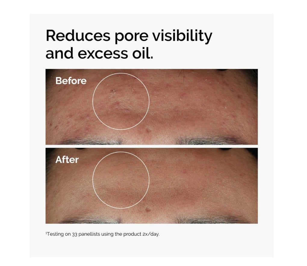 The Ordinary- Niacinamide 10% + Zinc 1% Brightening Serum