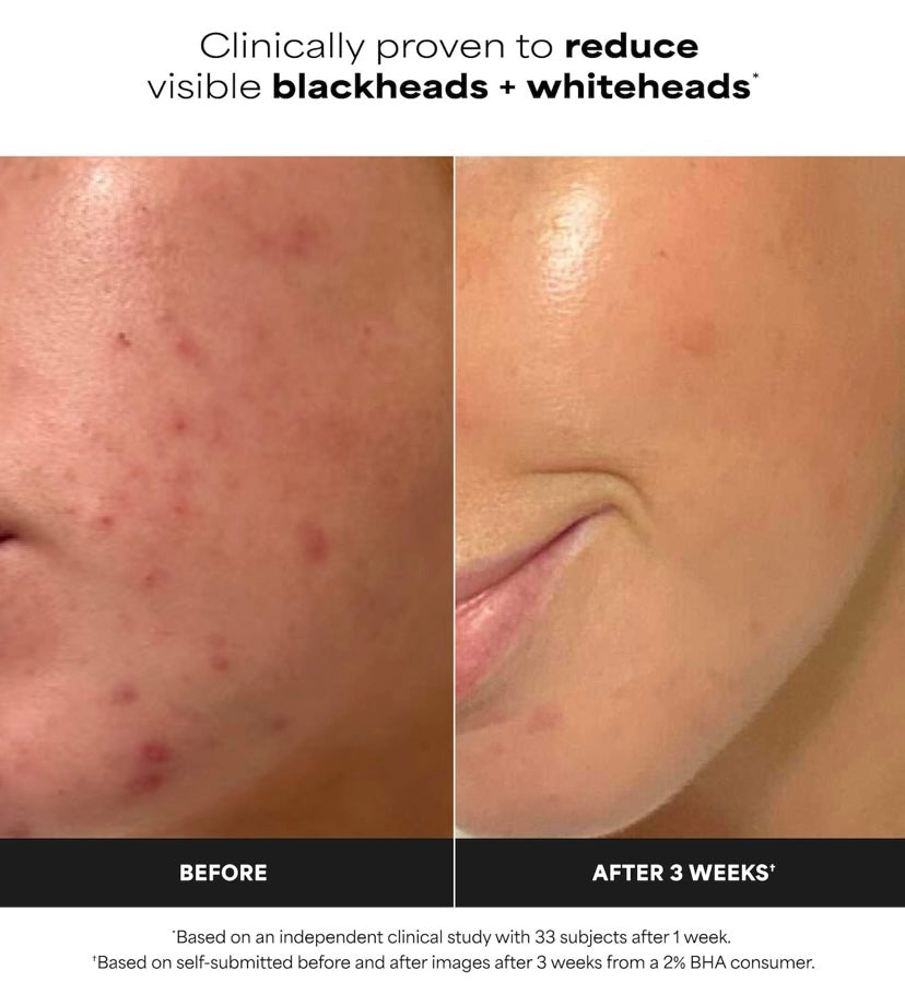 Paula’s Choice- Skin Perfecting 2% BHA Exfoliating Toner Pads for Clear Skin