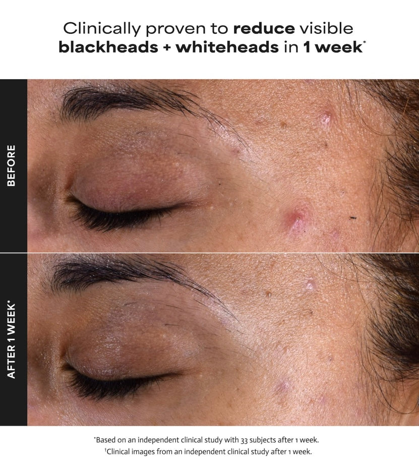 Paula’s Choice- Skin Perfecting 2% BHA Exfoliating Toner Pads for Clear Skin