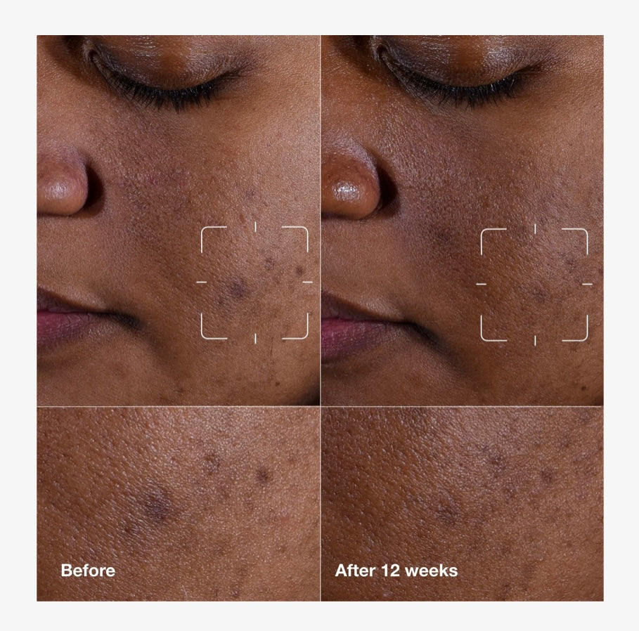 Clinique- Even Better Clinical Radical Dark Spot Corrector + Interrupter Serum