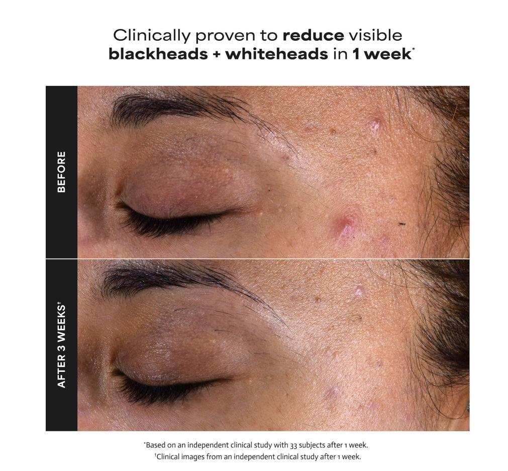 PAULA’S CHOICE- Skin Perfecting 2% BHA Exfoliating Toner for Clear Skin