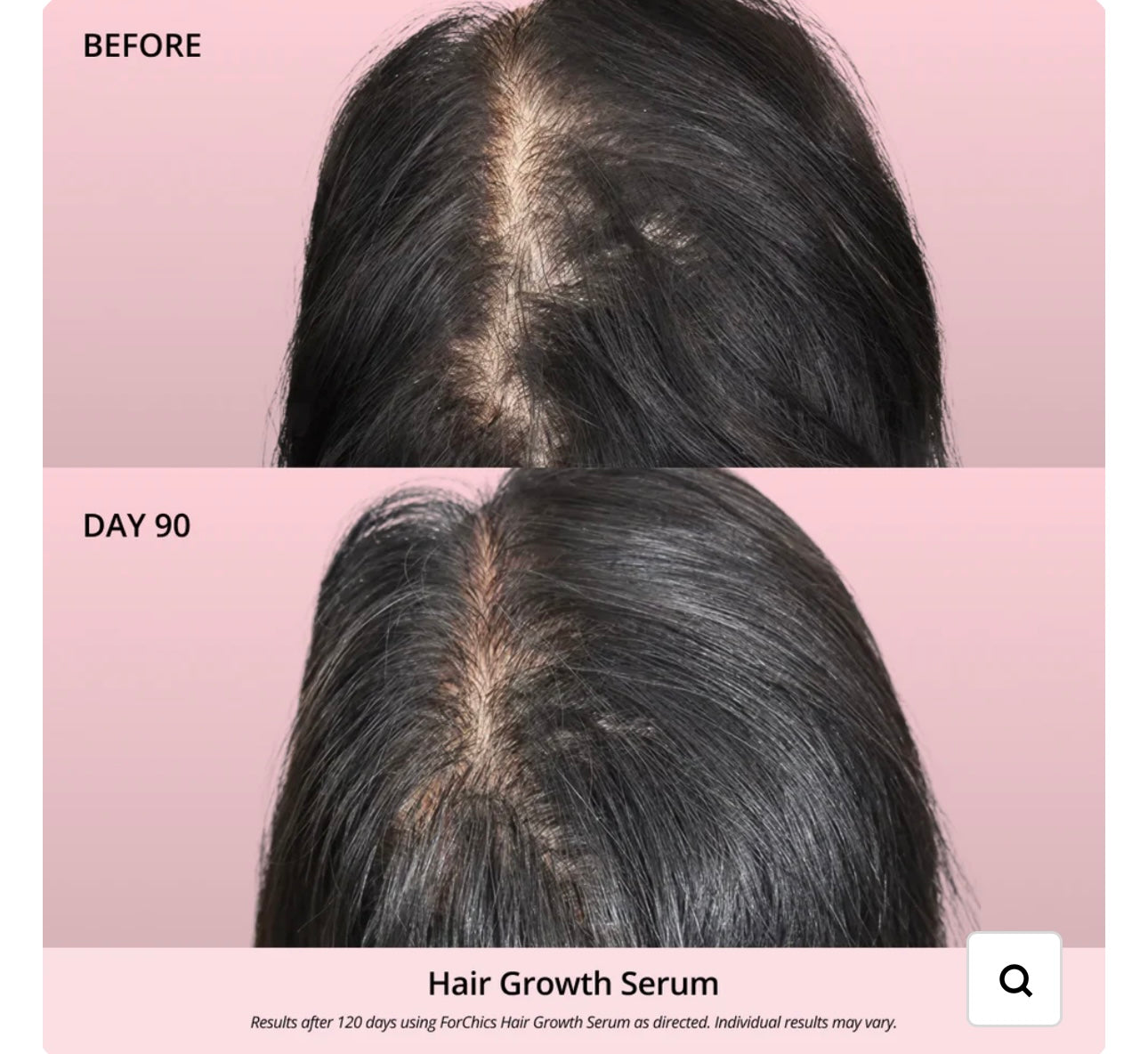 FORCHICS- Hair Growth Oil Spray