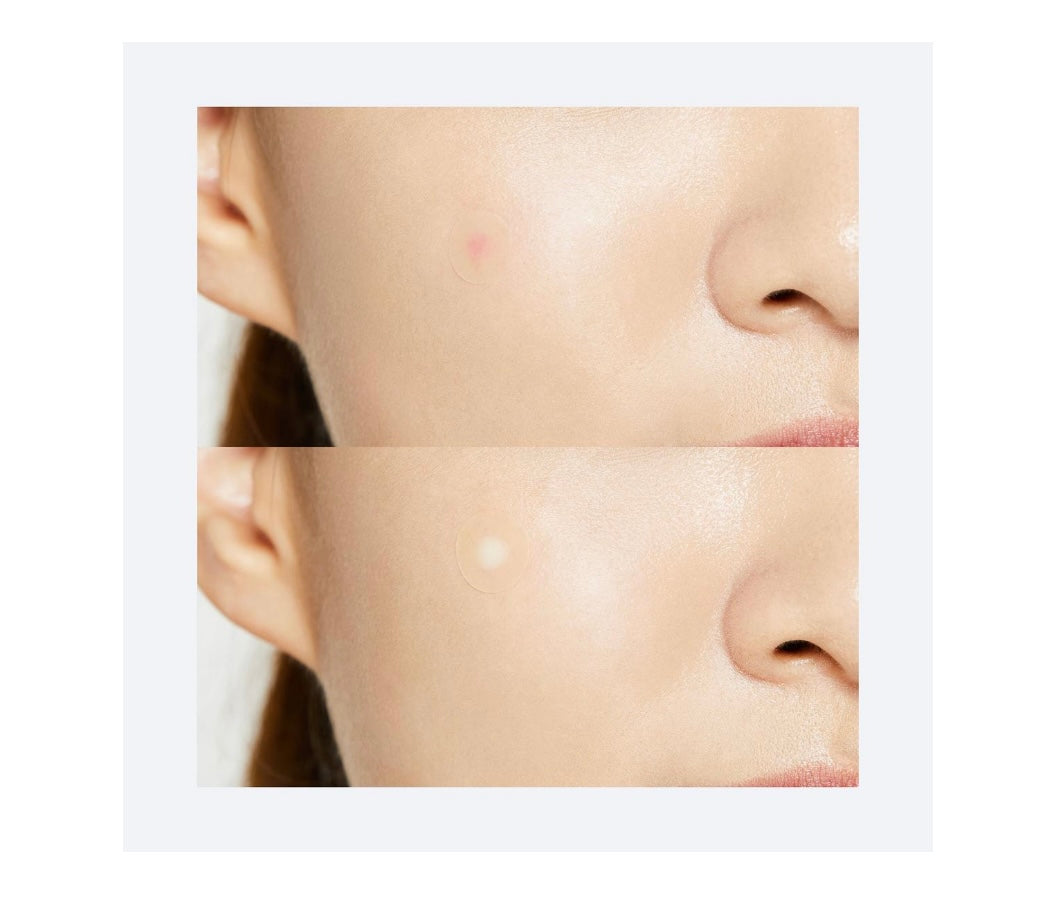 Cosrx- Acne Pimple Master Patch