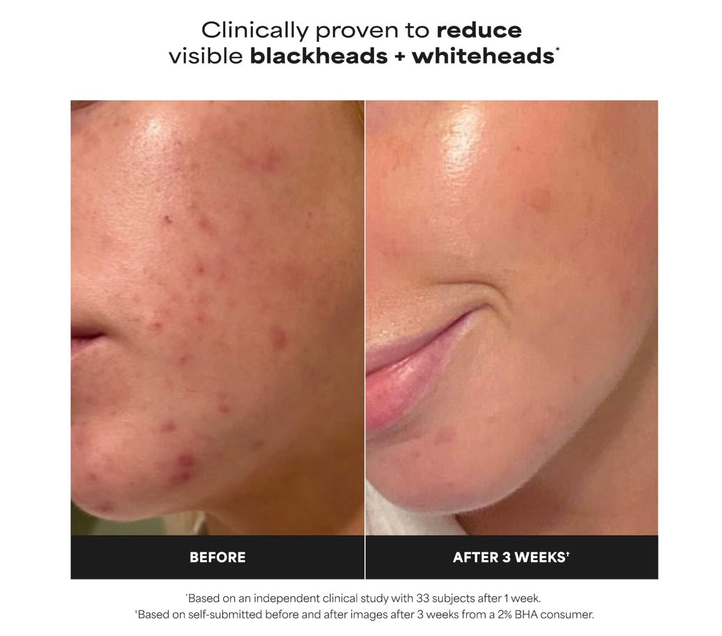 PAULA’S CHOICE- Skin Perfecting 2% BHA Exfoliating Toner for Clear Skin
